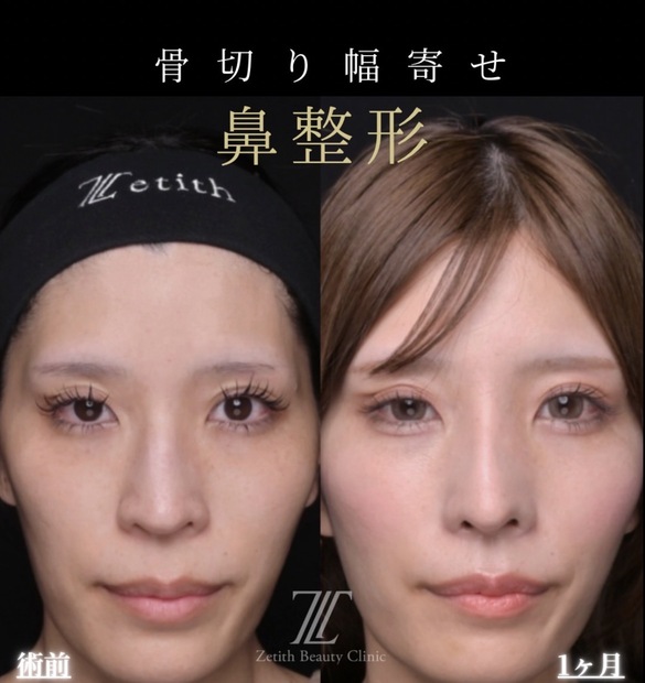 鼻整形のビフォーアフター写真
