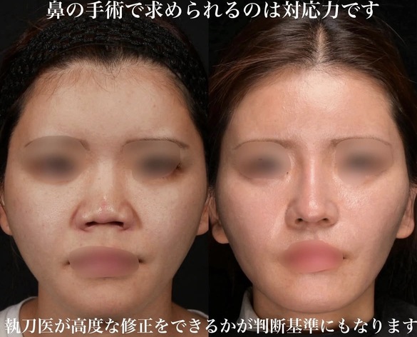 鼻整形のビフォーアフター写真