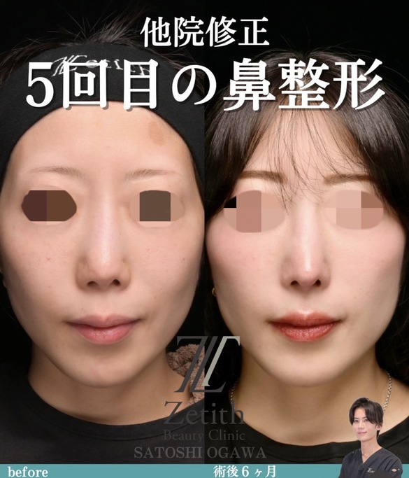 鼻整形のビフォアフター写真