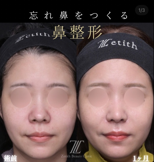 鼻整形のビフォーアフター写真