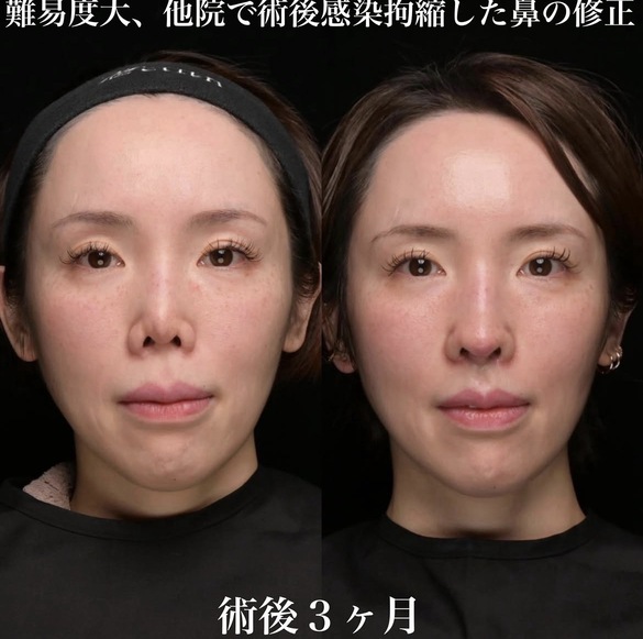 鼻整形のビフォーアフター写真