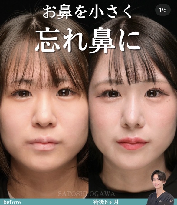 鼻整形のビフォーアフター写真
