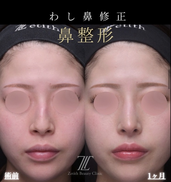 鼻整形のビフォーアフター写真