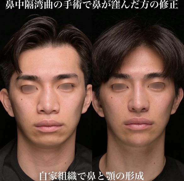 鼻整形のビフォーアフター写真