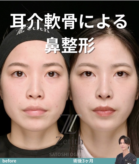 鼻整形のビフォーアフター写真