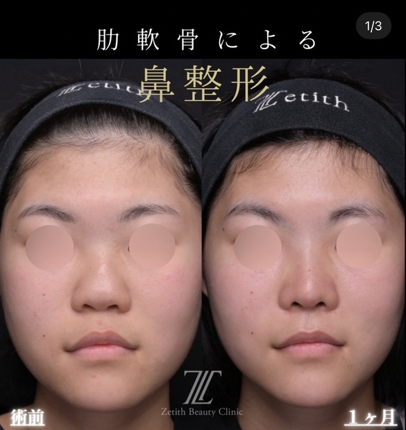 鼻整形のビフォーアフター写真