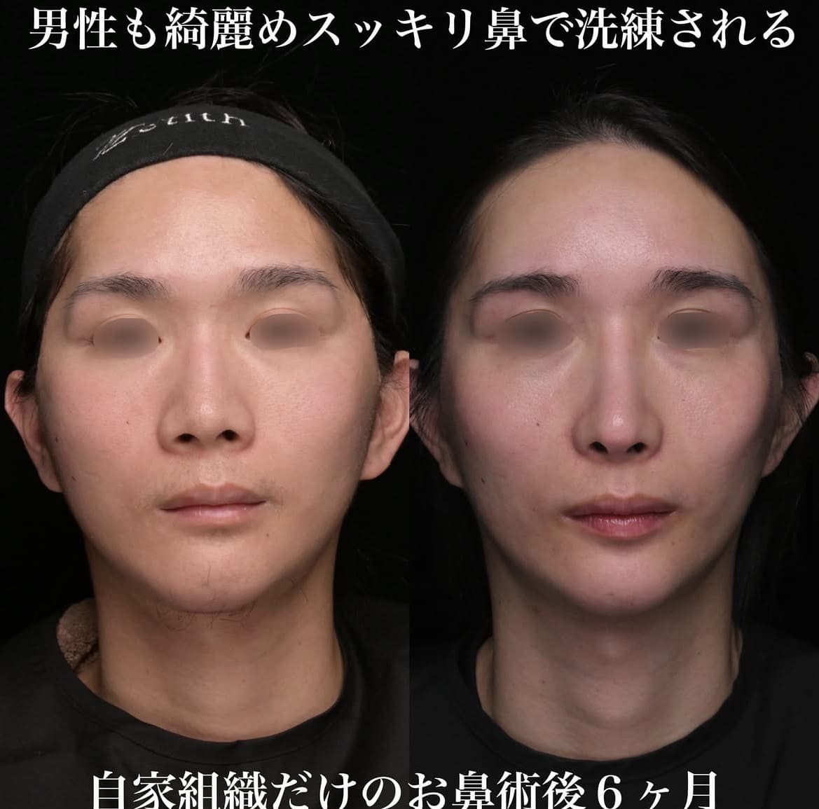 鼻整形のビフォーアフター写真