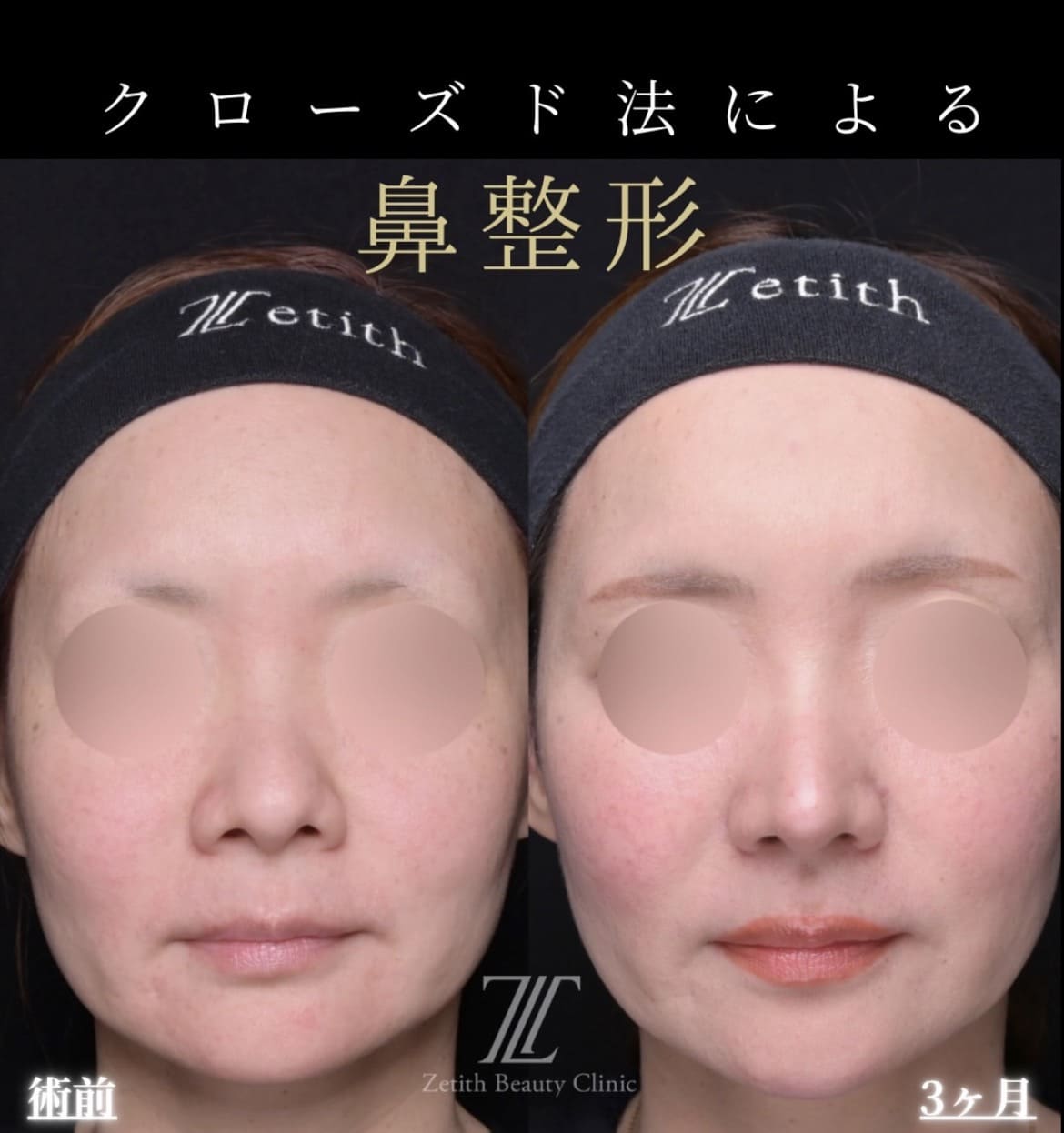 鼻整形のビフォーアフター写真