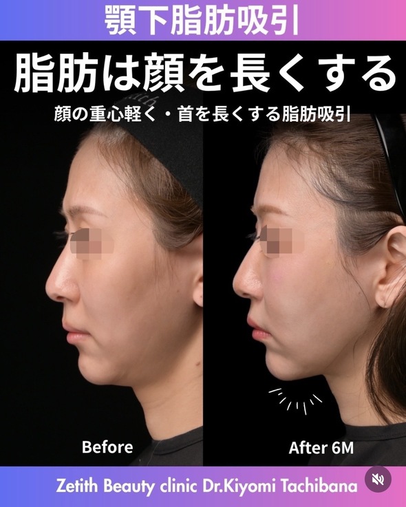 脂肪吸引のビフォーアフターの写真
