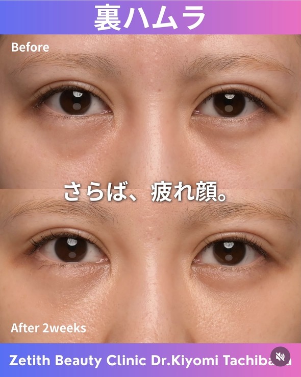 裏ハムラ法のビフォーアフターの写真