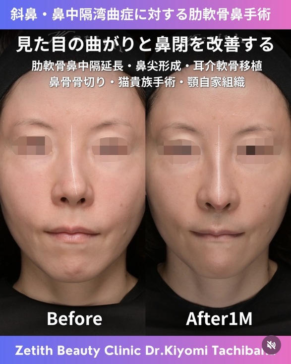 鼻整形のビフォーアフターの写真