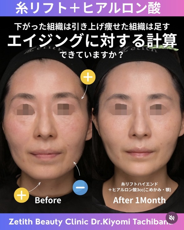 複合施術のビフォーアフターの写真