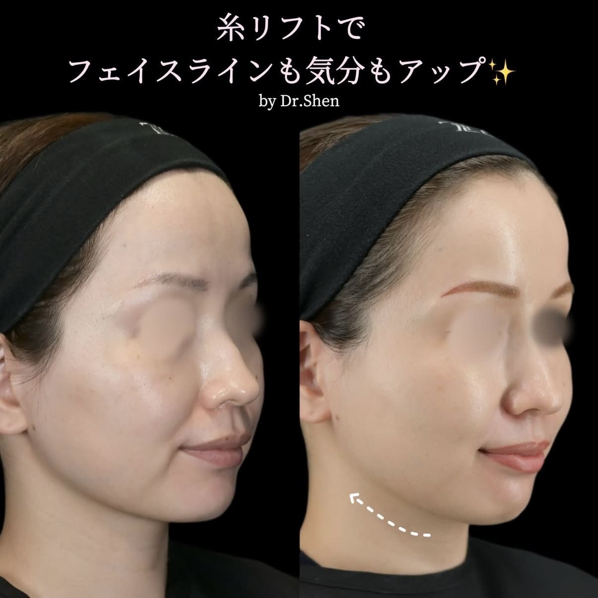 糸リフトのビフォーアフター写真