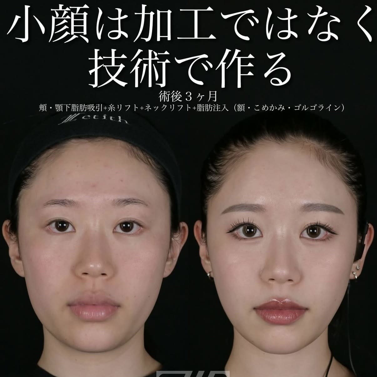 脂肪吸引リフトのビフォーアフター写真