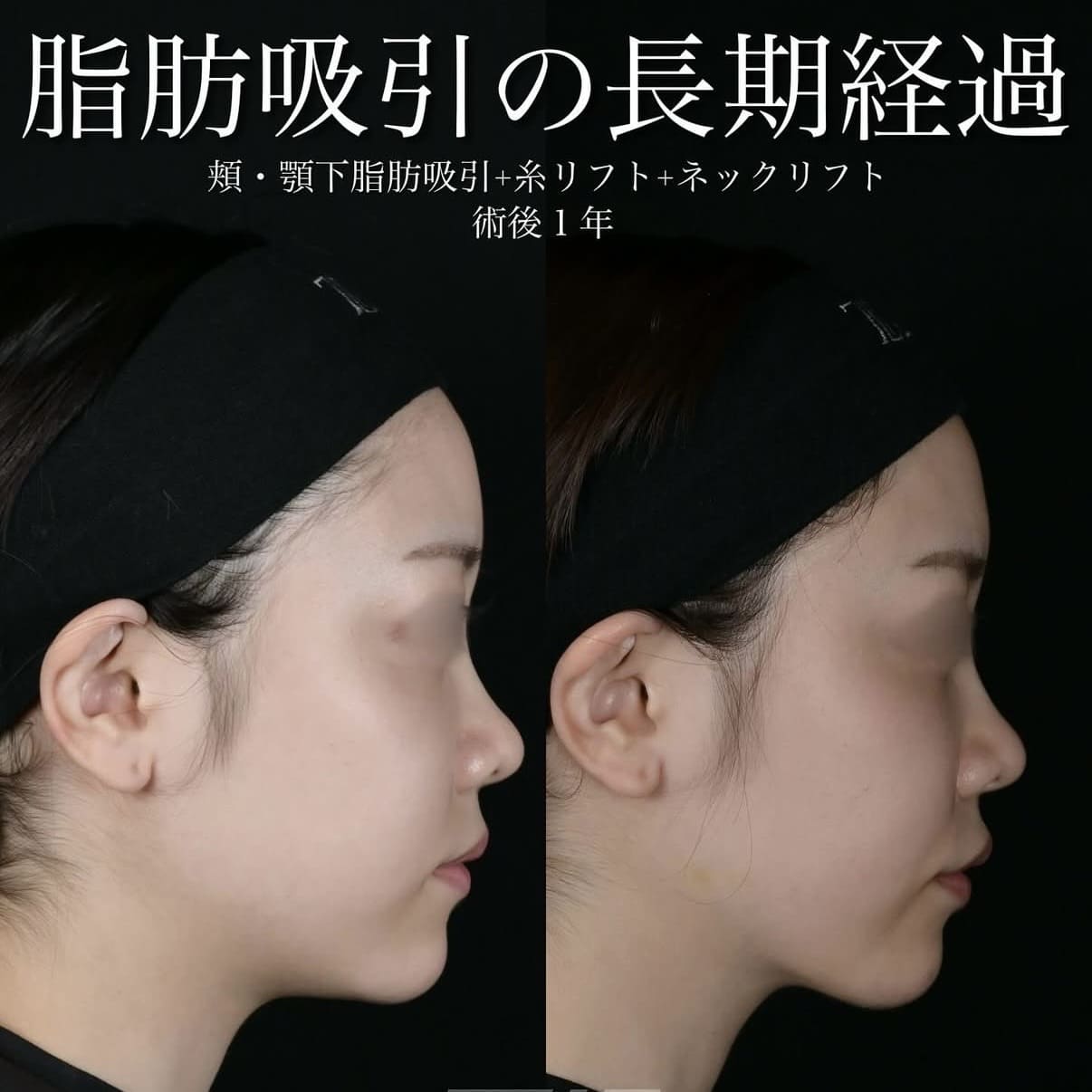 脂肪吸引リフトのビフォーアフター写真