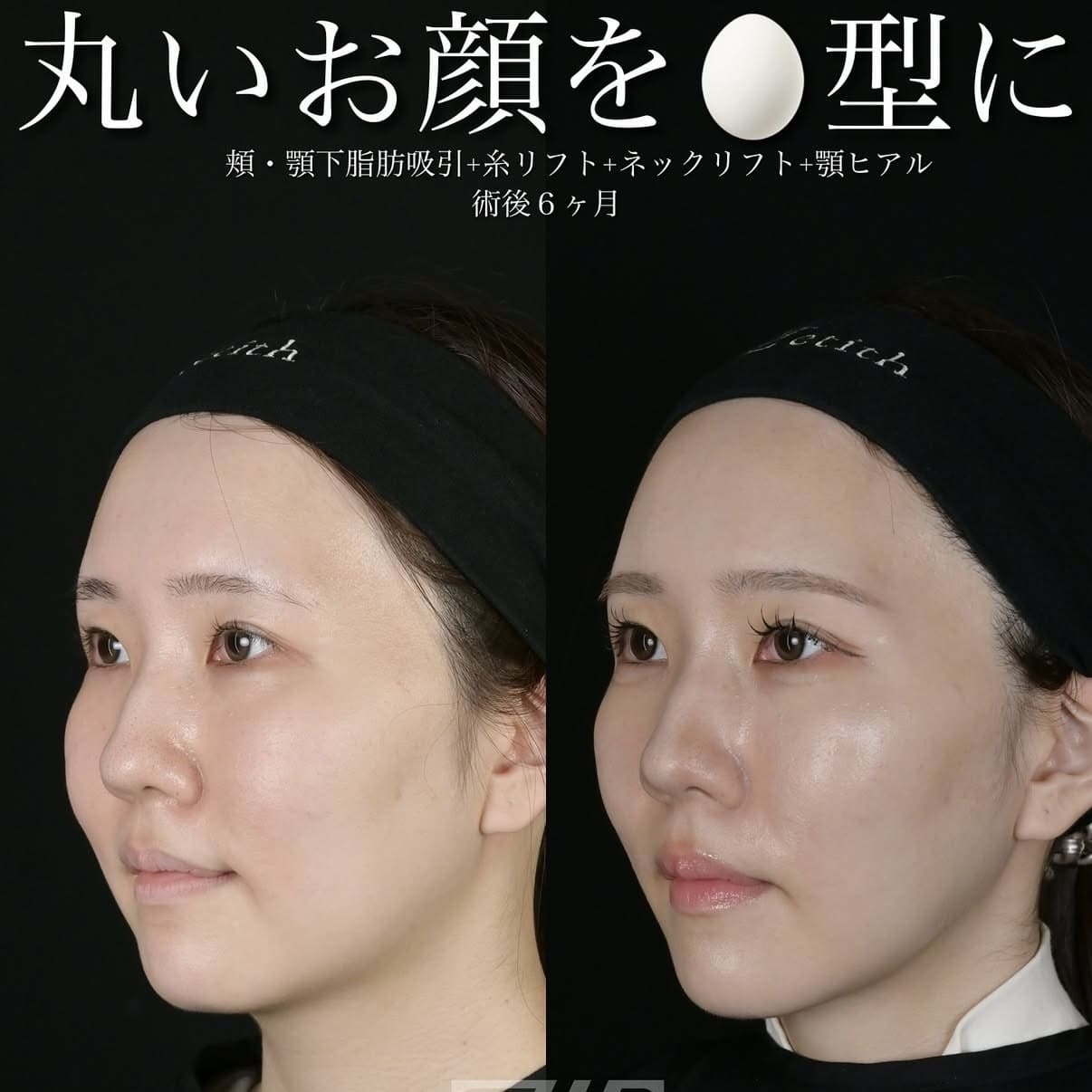 脂肪吸引リフトのビフォーアフター写真