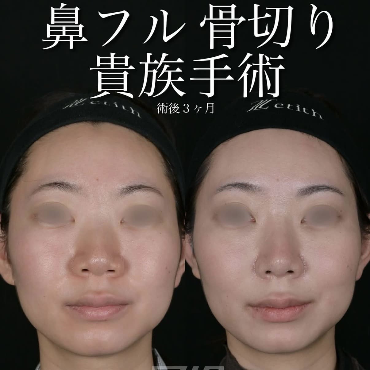 鼻整形のビフォーアフター写真