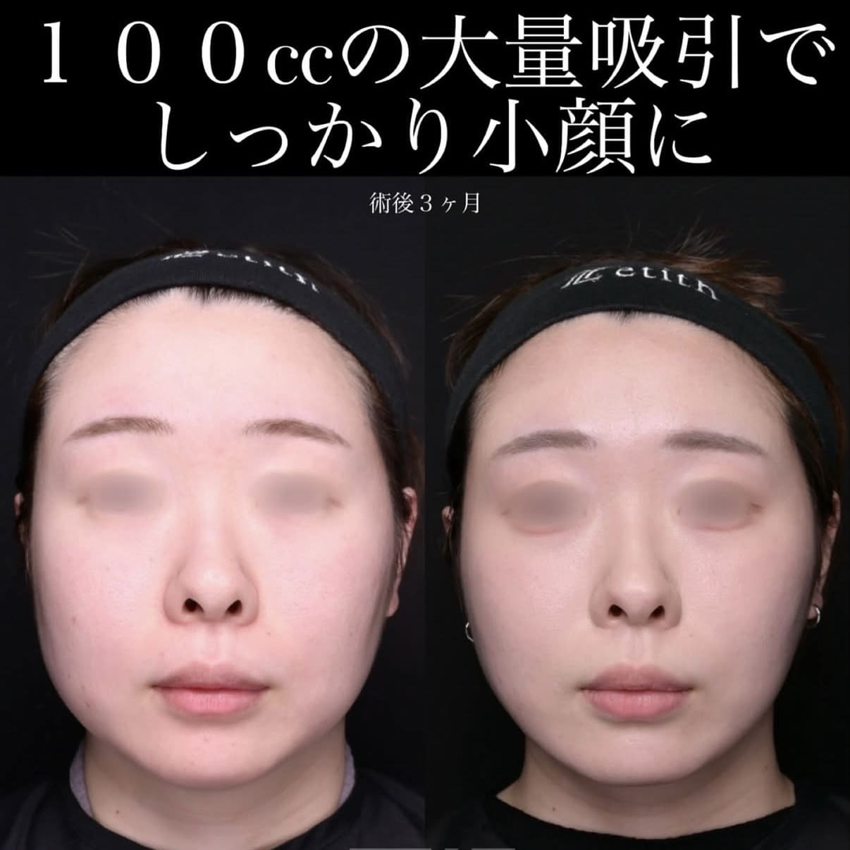 脂肪吸引リフトのビフォーアフター写真