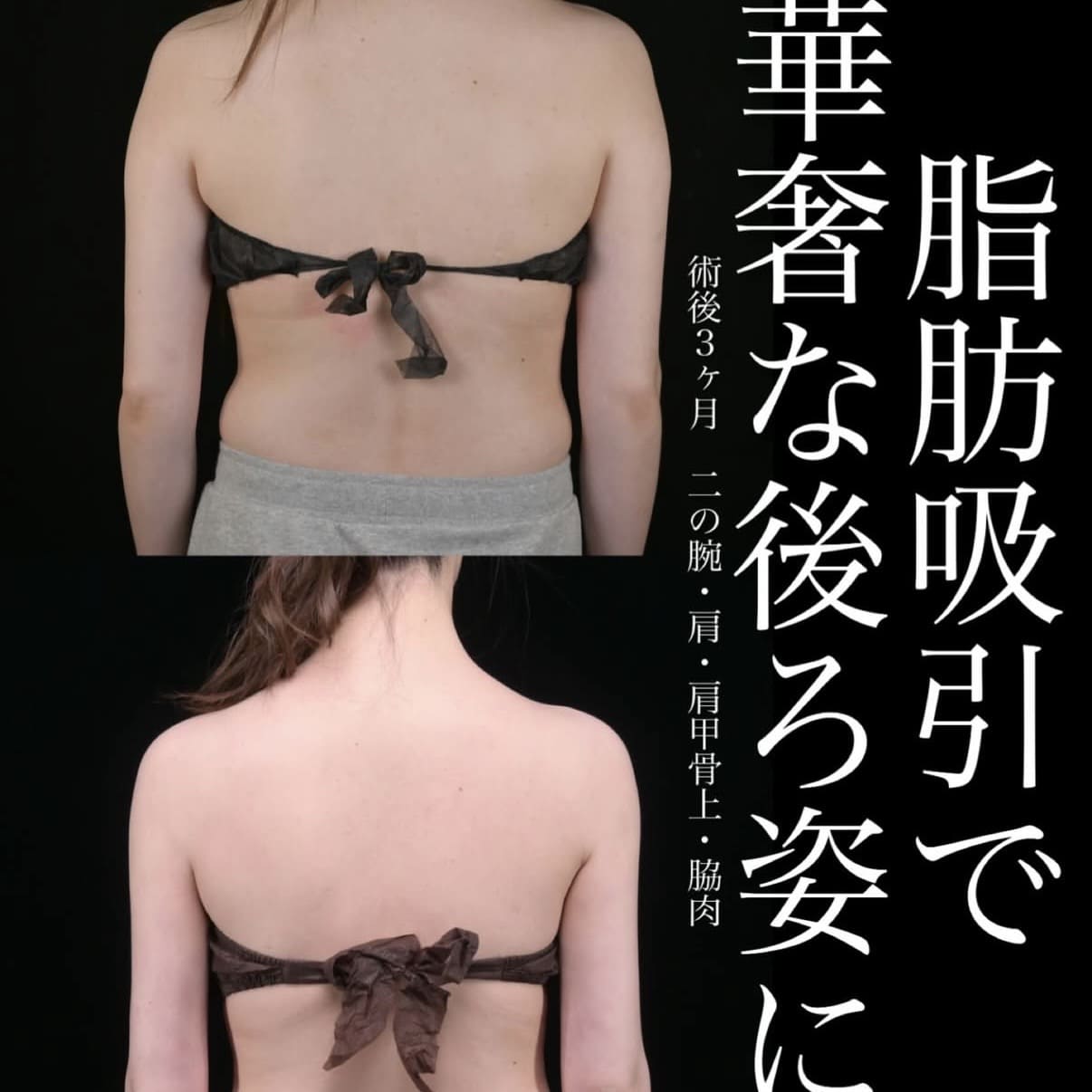 脂肪吸引のビフォーアフター写真