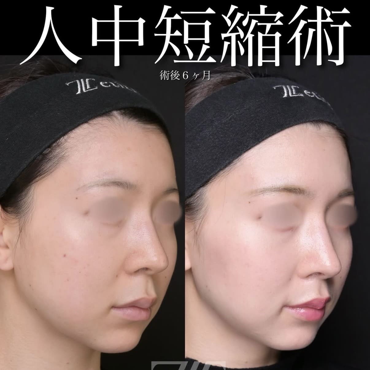 人中短縮のビフォーアフター写真