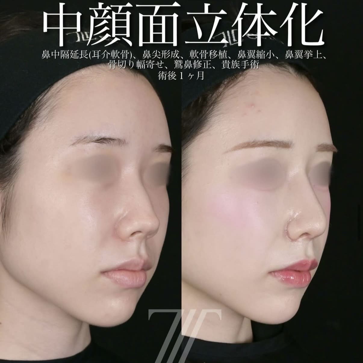 鼻整形のビフォーアフター写真