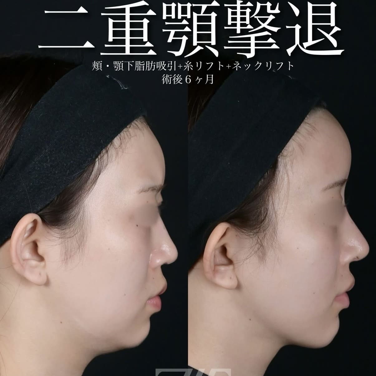脂肪吸引リフトのビフォーアフター写真