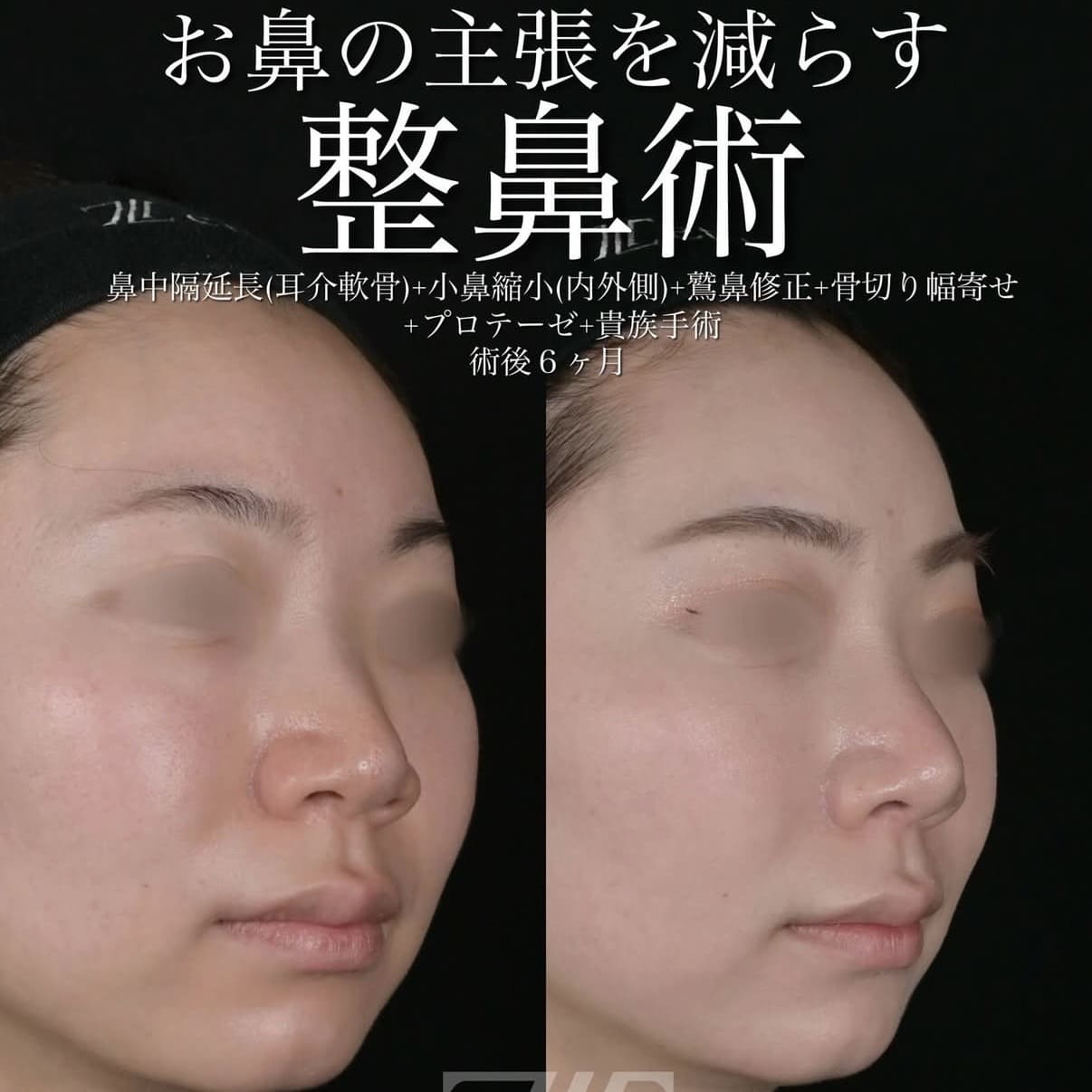 鼻整形のビフォーアフター写真