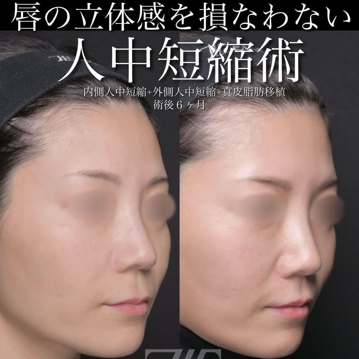 人中短縮のビフォーアフター写真