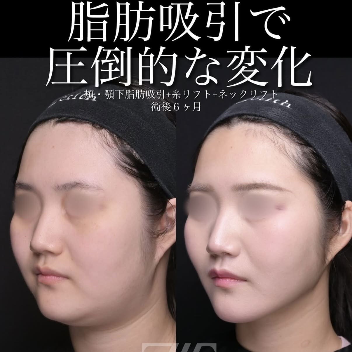 脂肪吸引リフトのビフォーアフター写真
