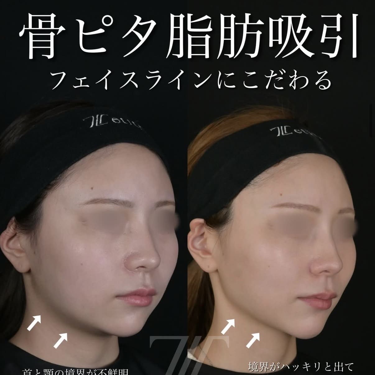 脂肪吸引リフトのビフォーアフター写真