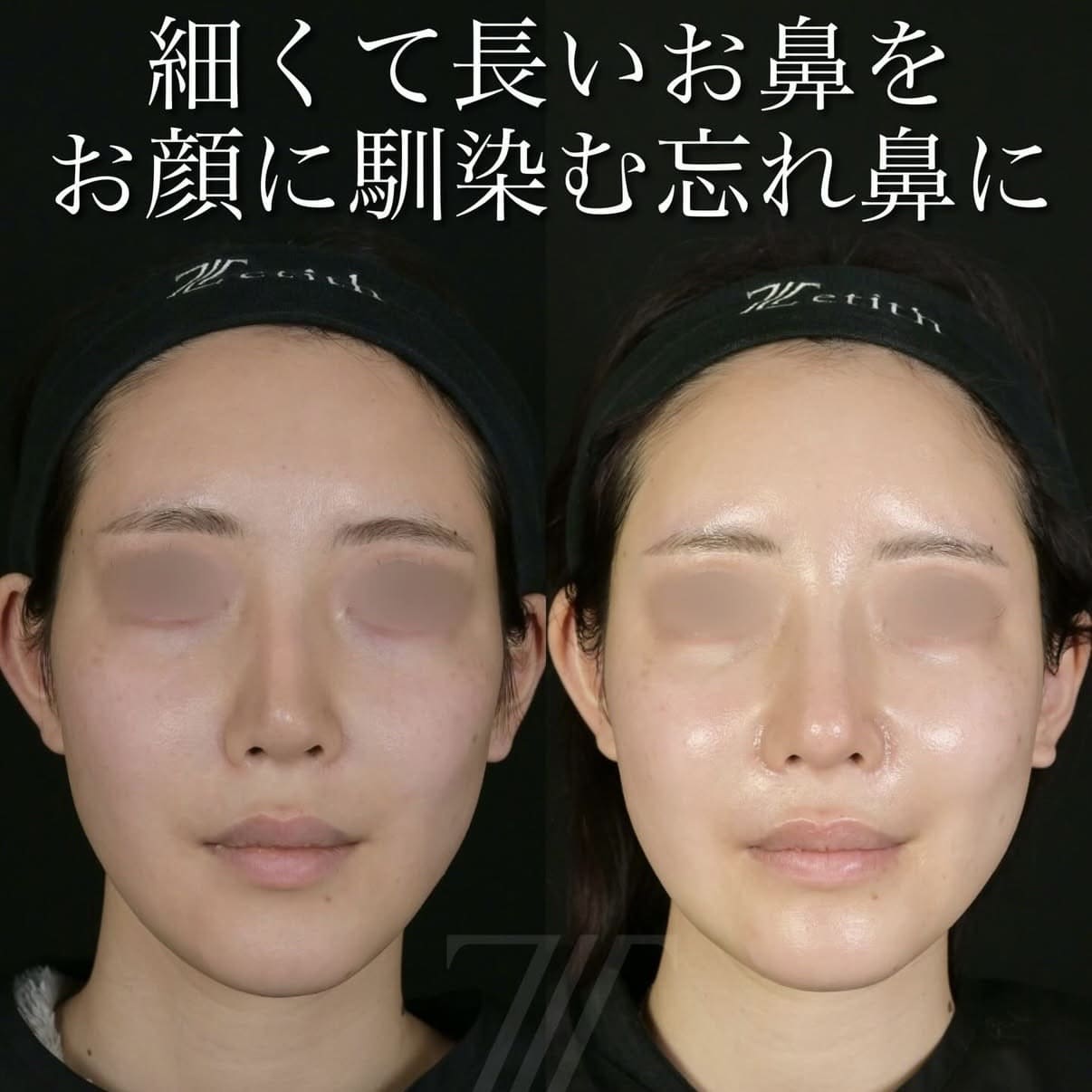 鼻整形のビフォーアフター写真