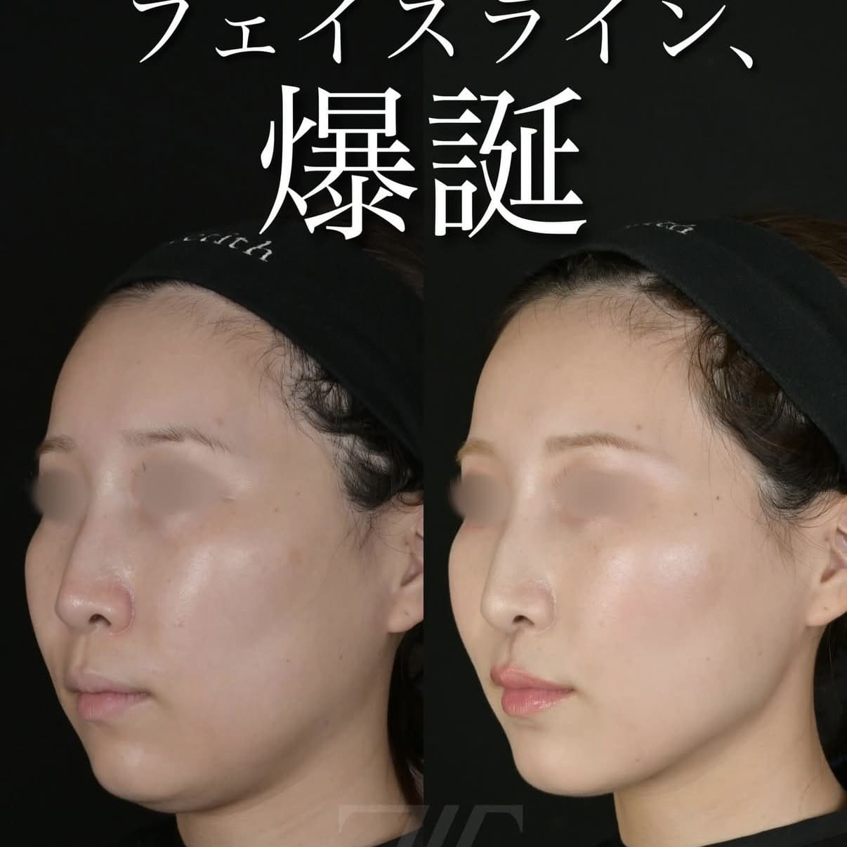 脂肪吸引リフトのビフォーアフター写真
