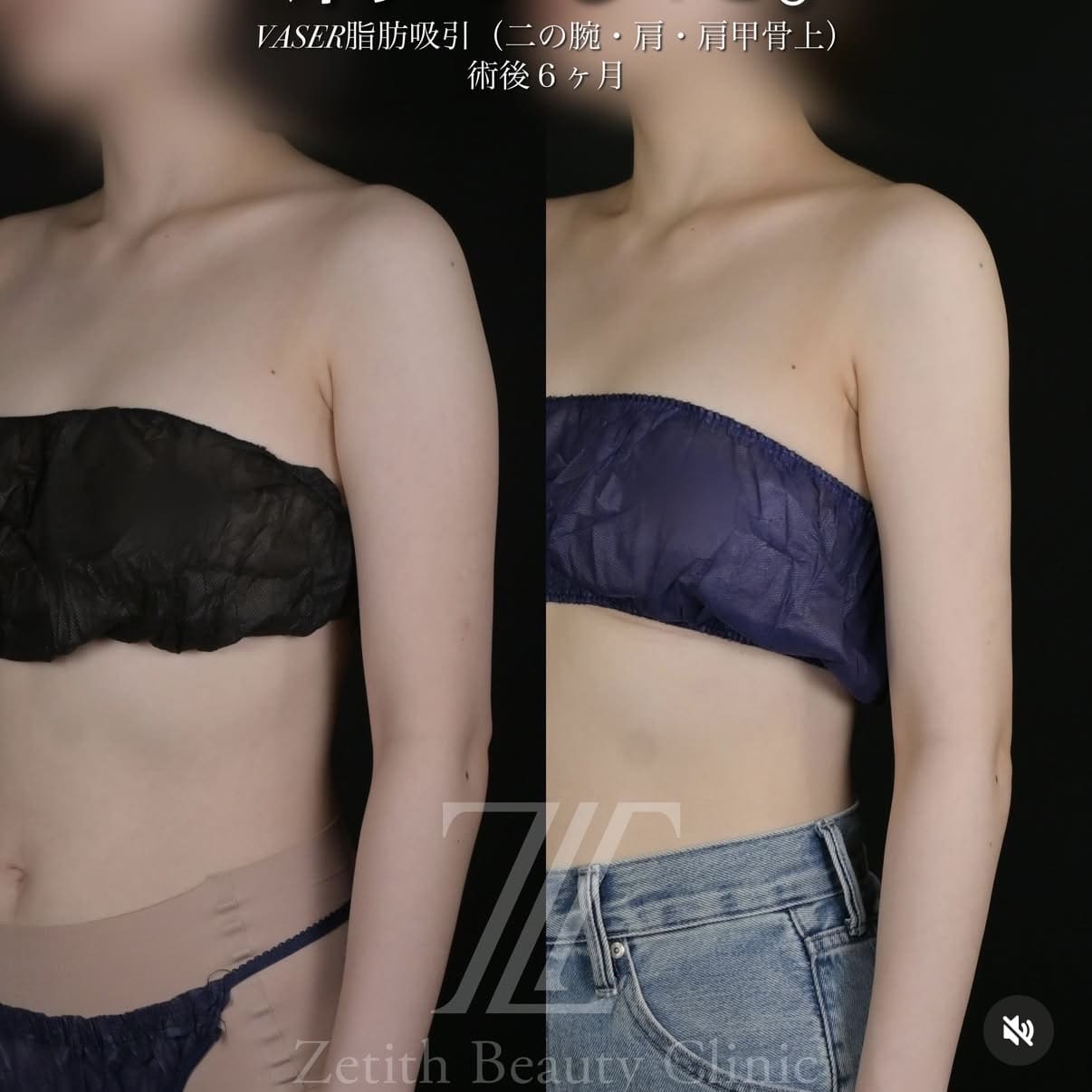 脂肪吸引のビフォーアフター写真