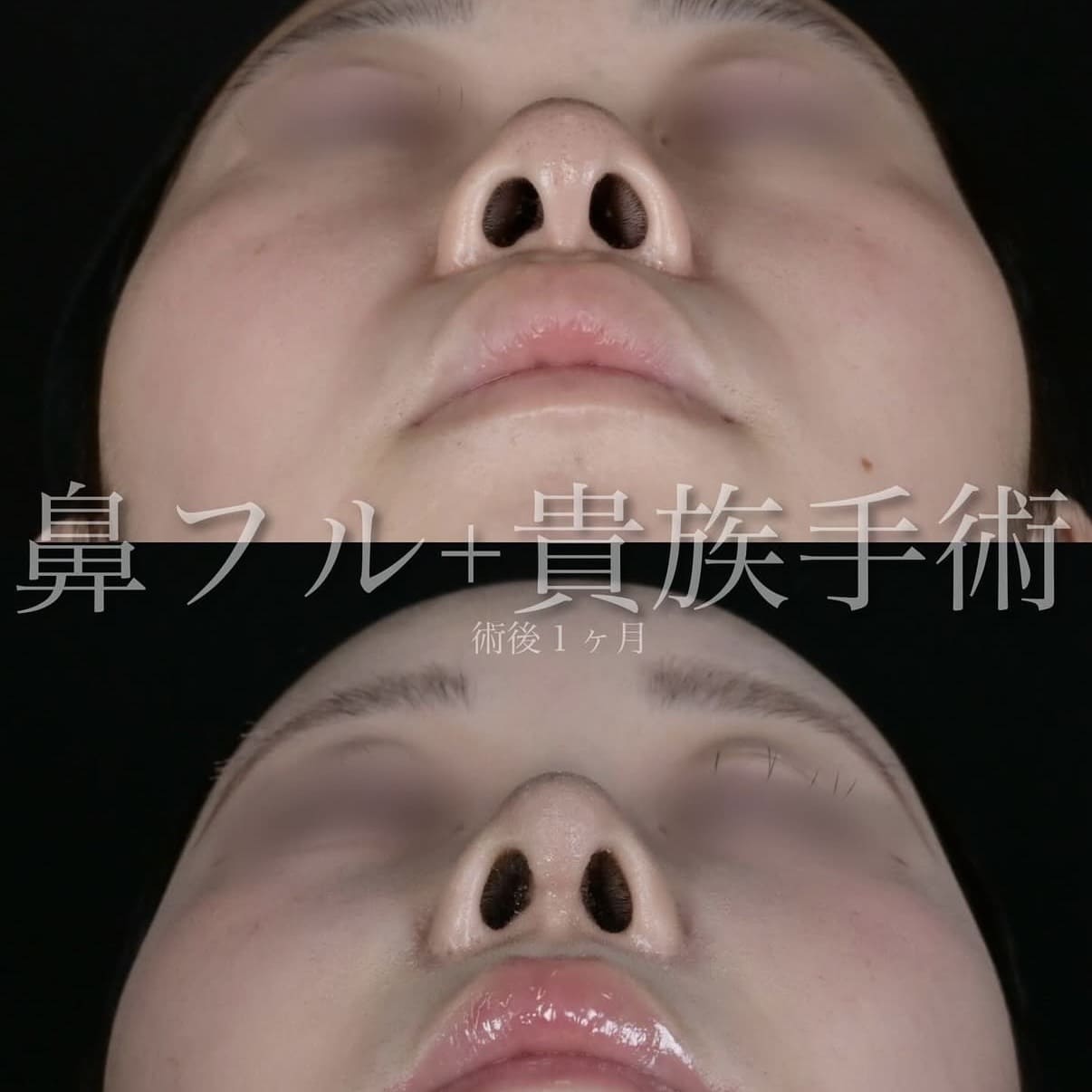 鼻整形のビフォーアフター写真