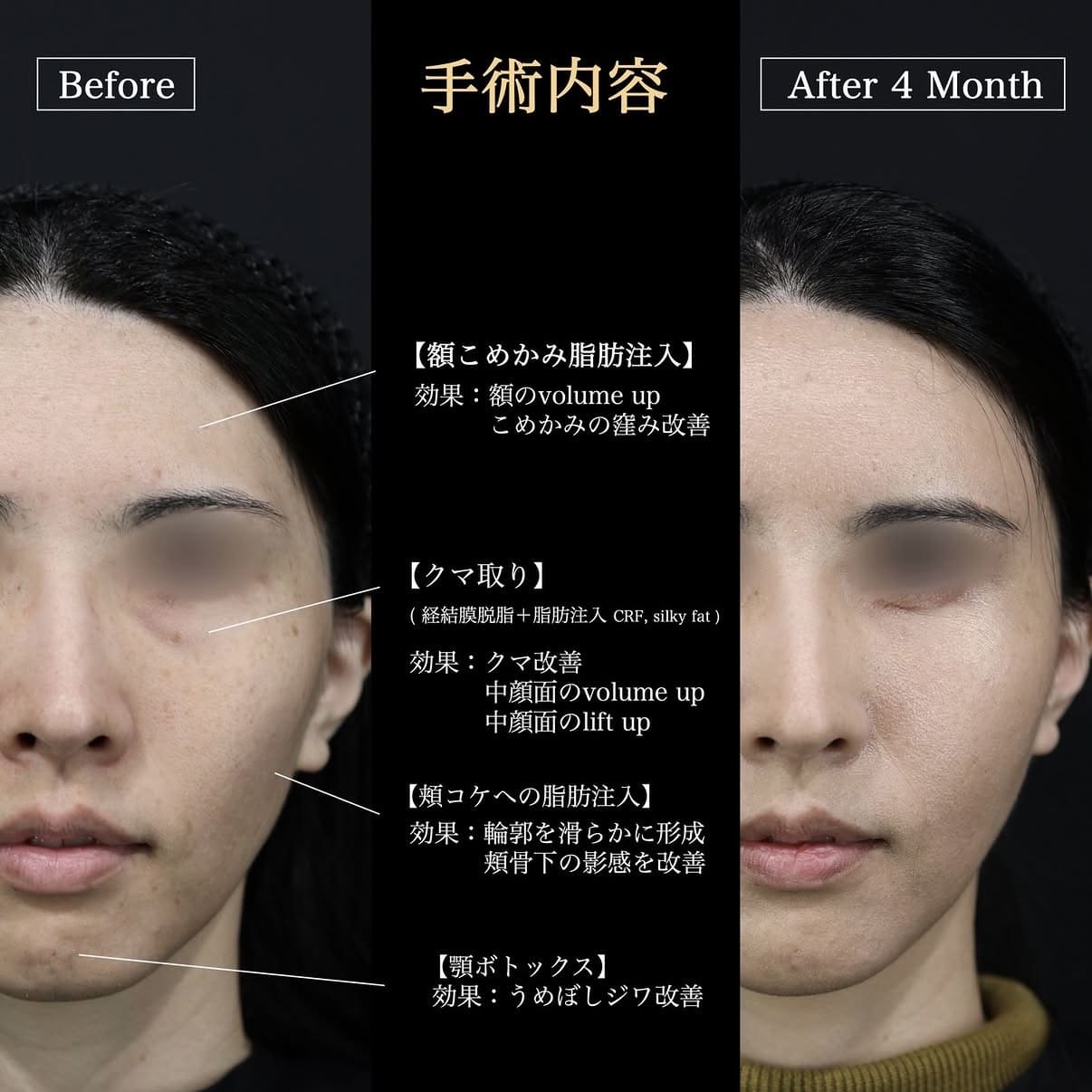 クマ取り、脂肪注入、ボトックス注入のビフォーアフター写真