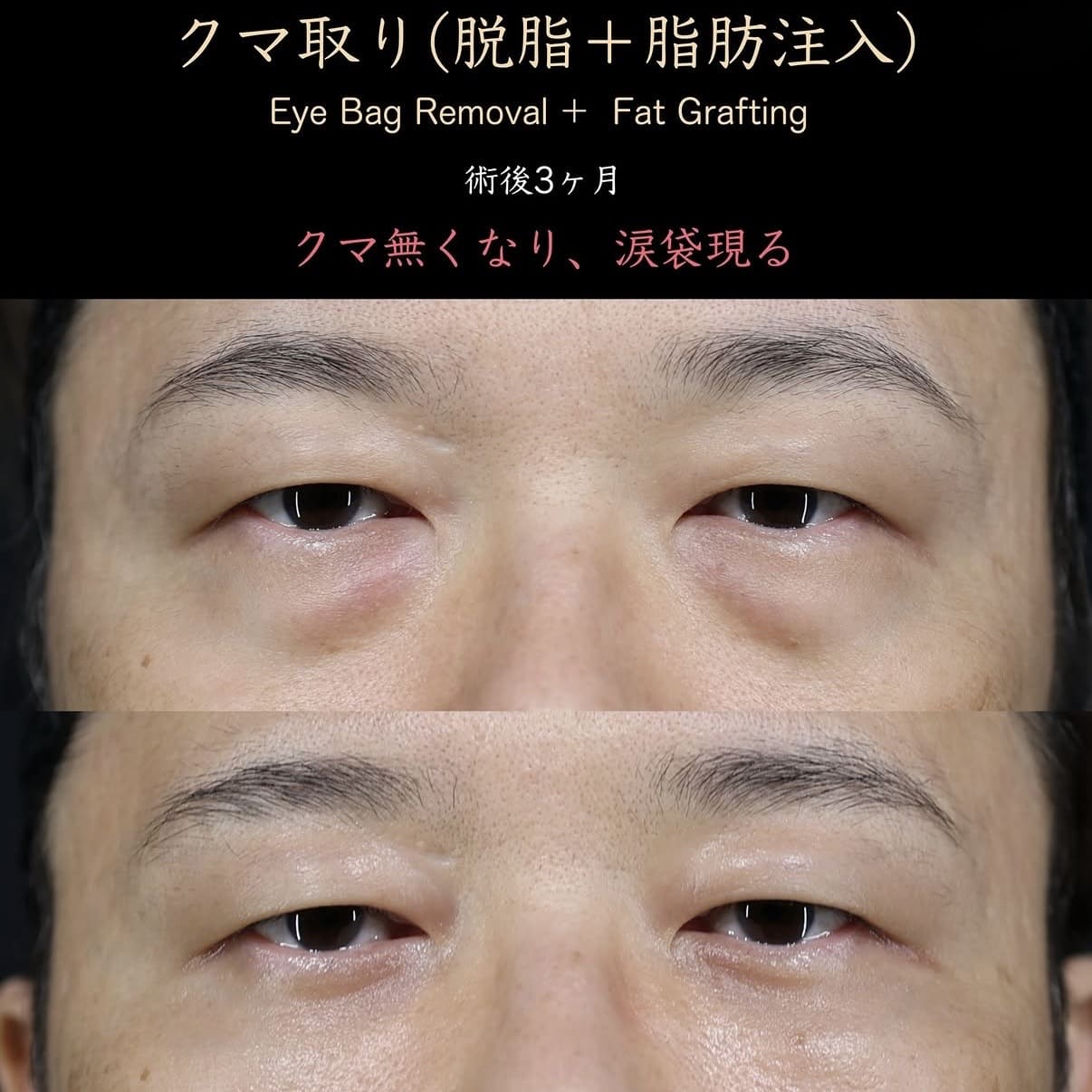 クマ治療のビフォーアフター写真