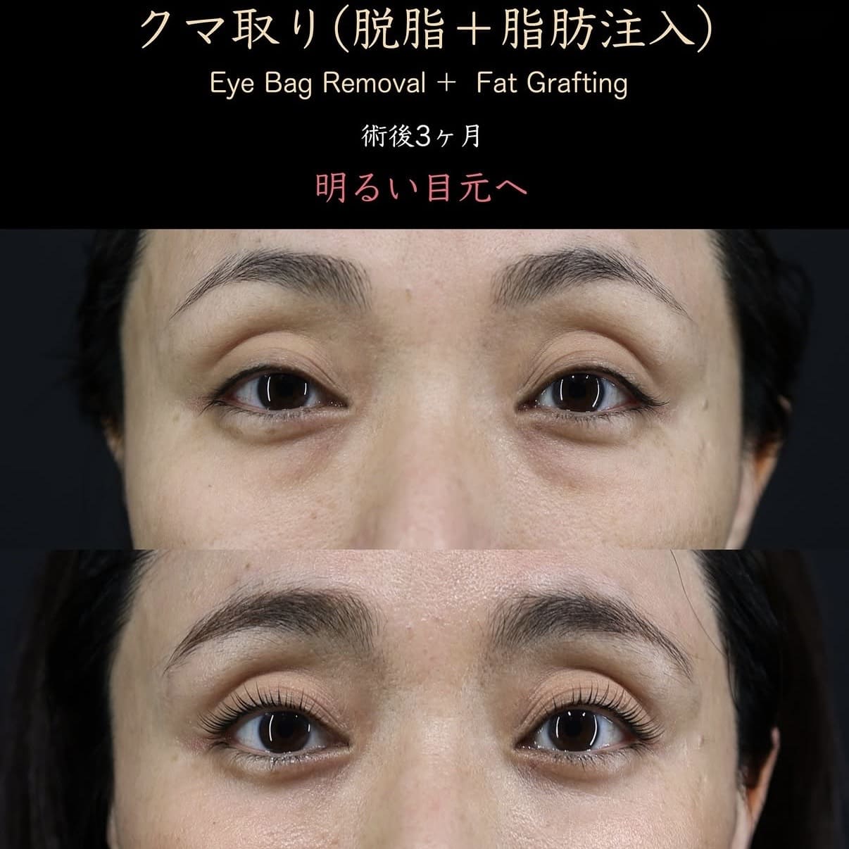 クマ治療のビフォーアフター写真