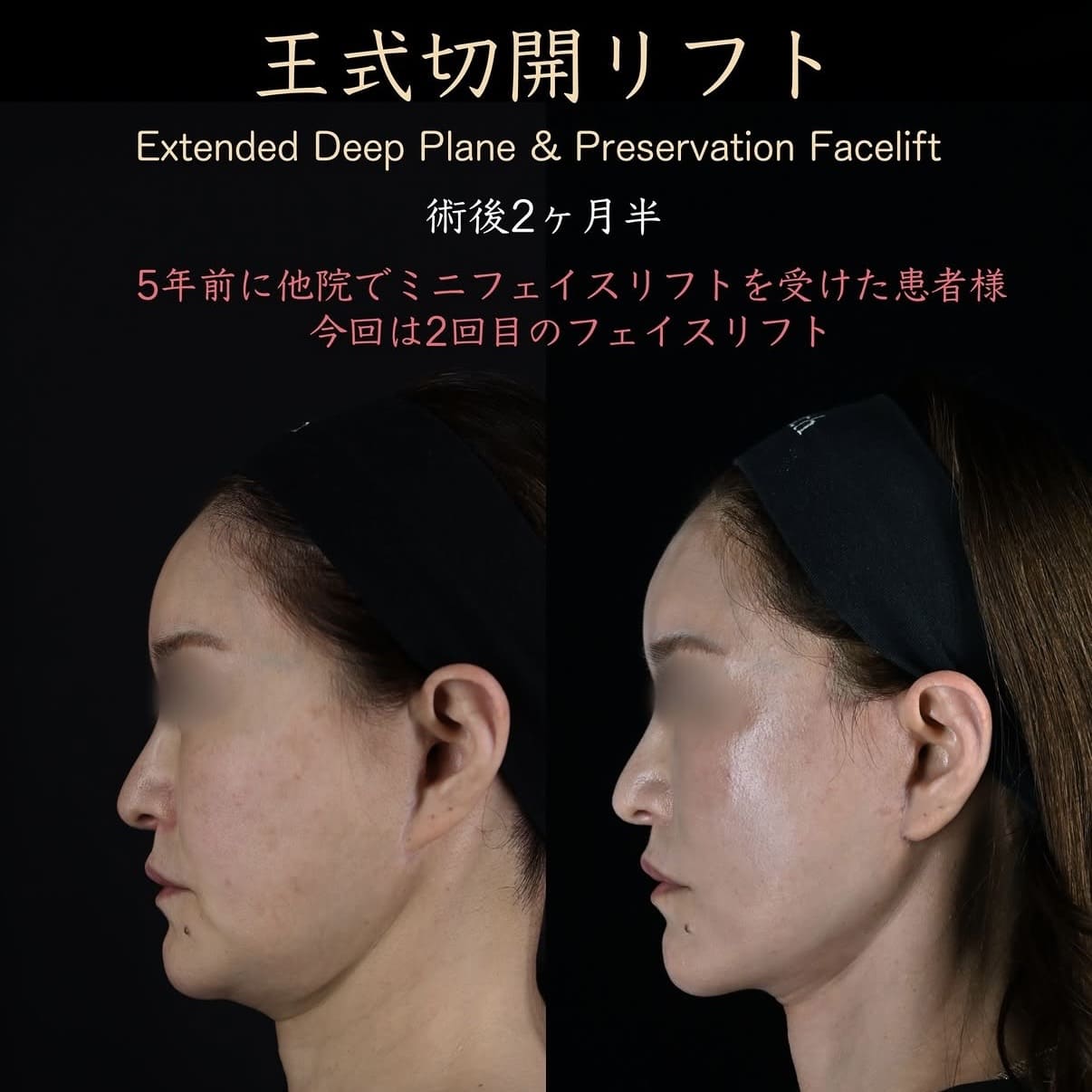 フェイスリフトのビフォーアフター写真