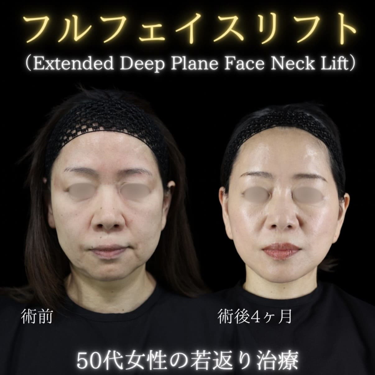 フェイスリフトのビフォーアフター写真