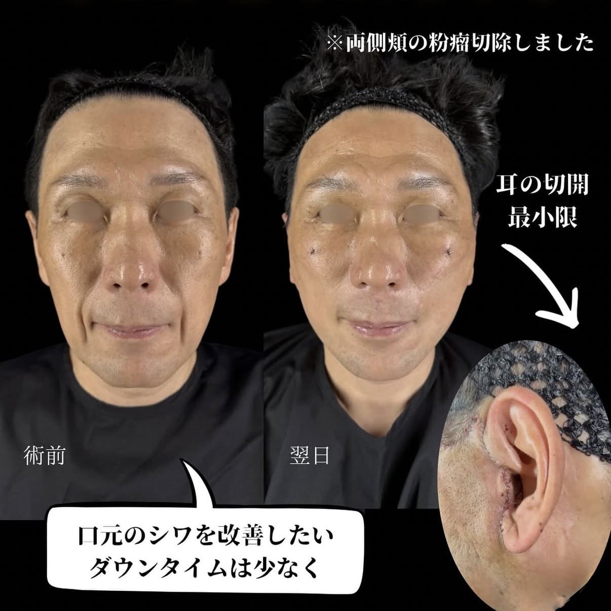 ミニフェイスリフトのビフォーアフター写真