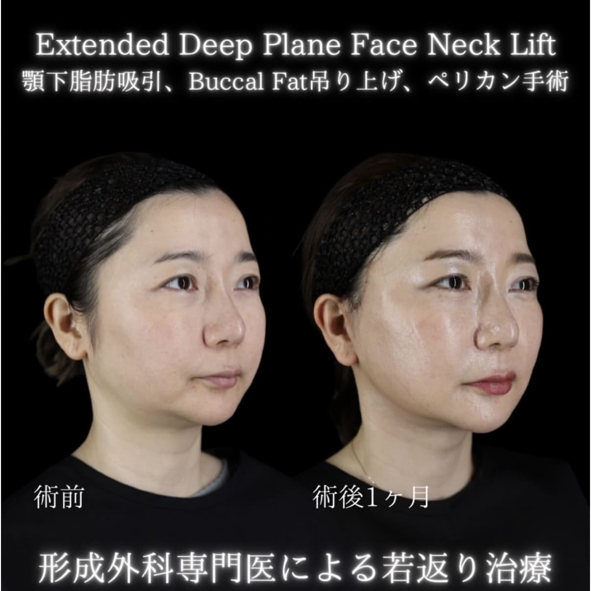 フェイスリフトのビフォーアフター写真