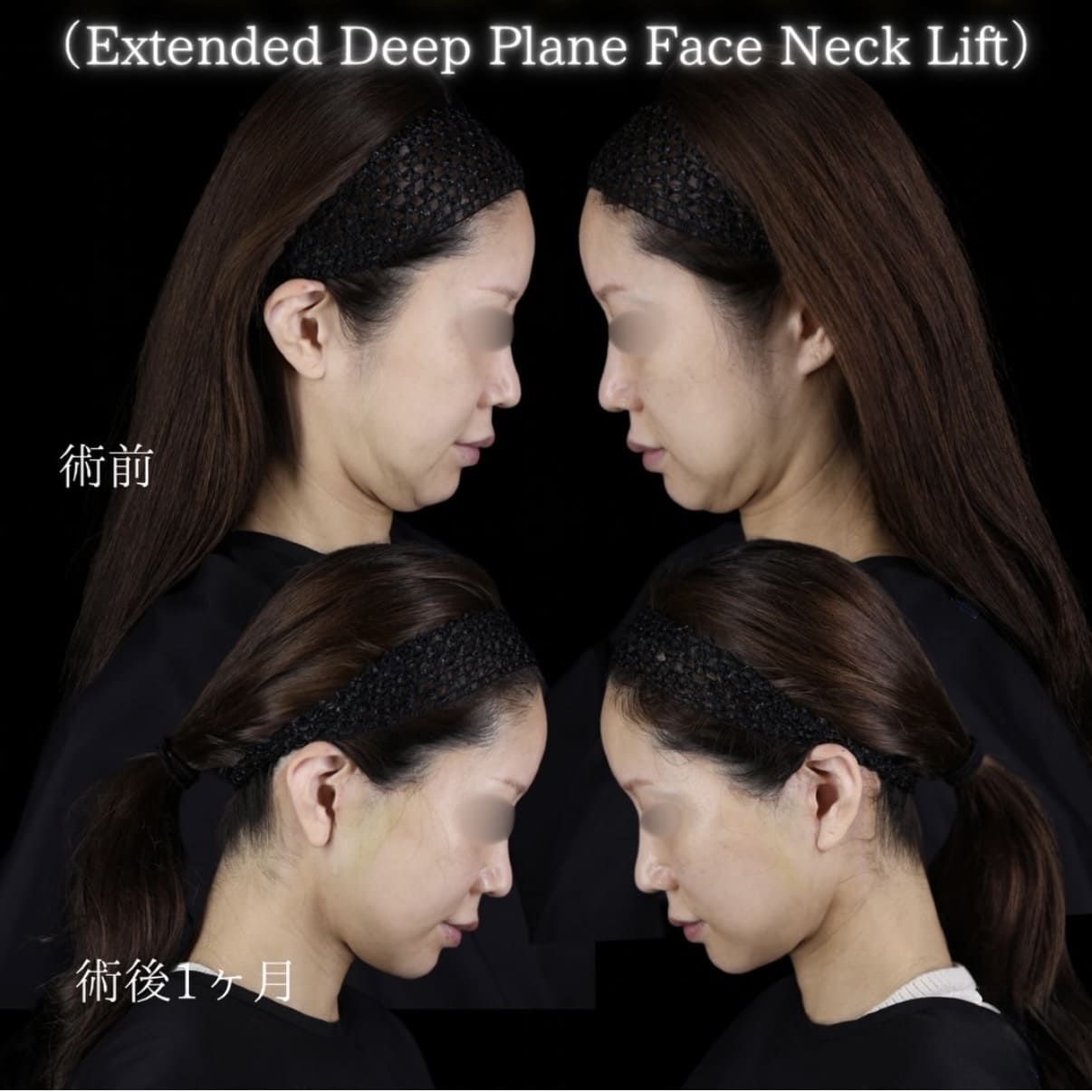 フェイスリフトのビフォーアフター写真
