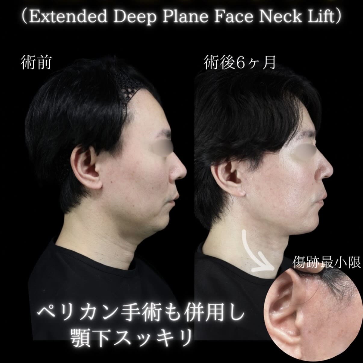 フェイスリフトのビフォーアフター写真