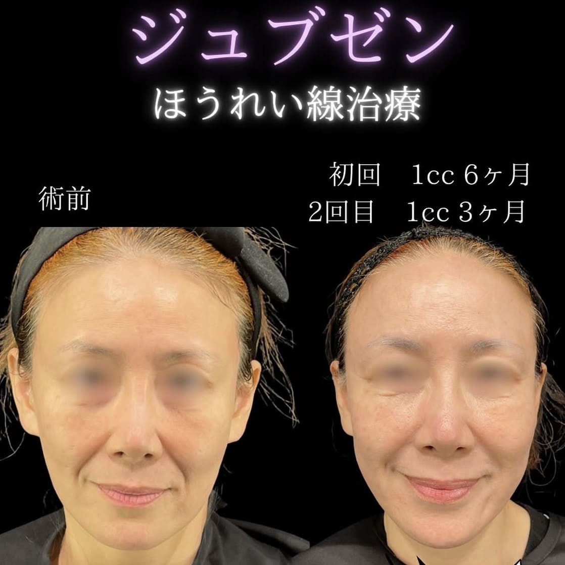 ジュブゼンのビフォーアフター写真
