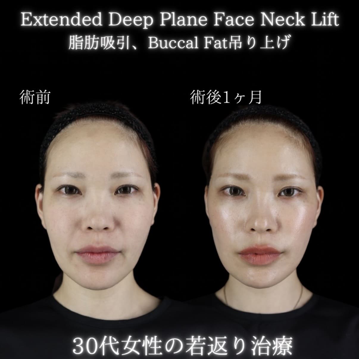 フェイスリフトのビフォーアフター写真
