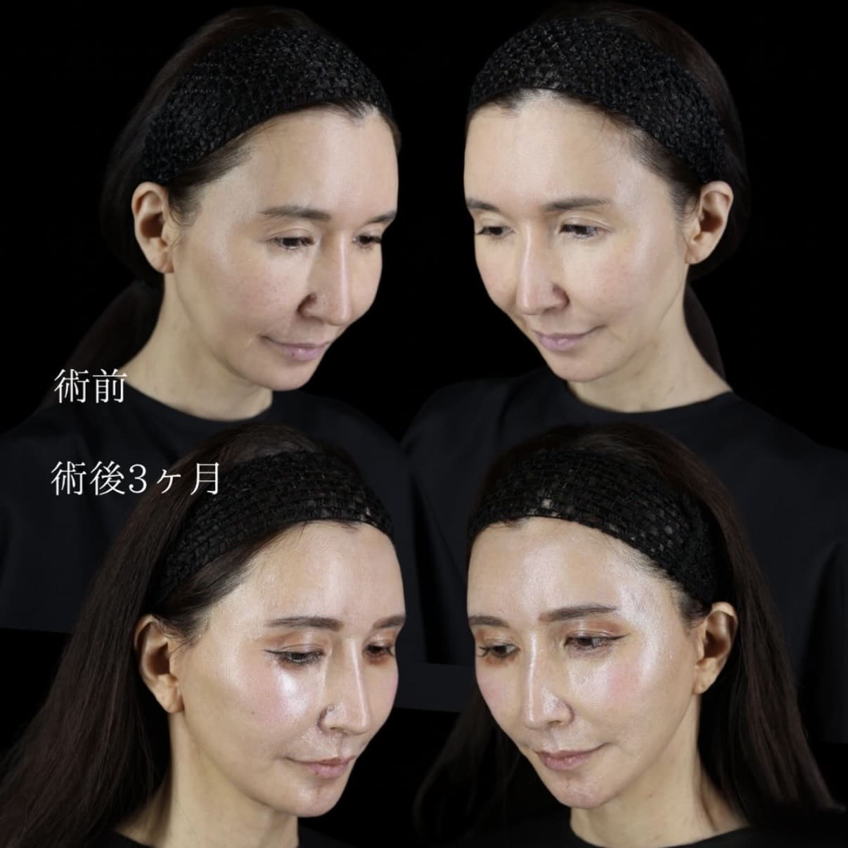 フェイスリフトのビフォーアフター写真