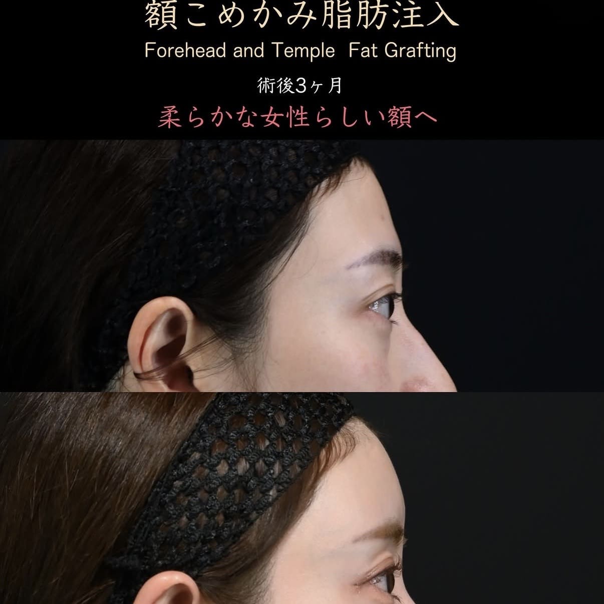 脂肪注入のビフォーアフター写真