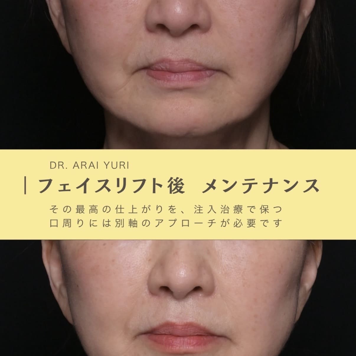 ジュブゼン、ヒアルロン酸注入、ボトックス注入のビフォーアフター写真