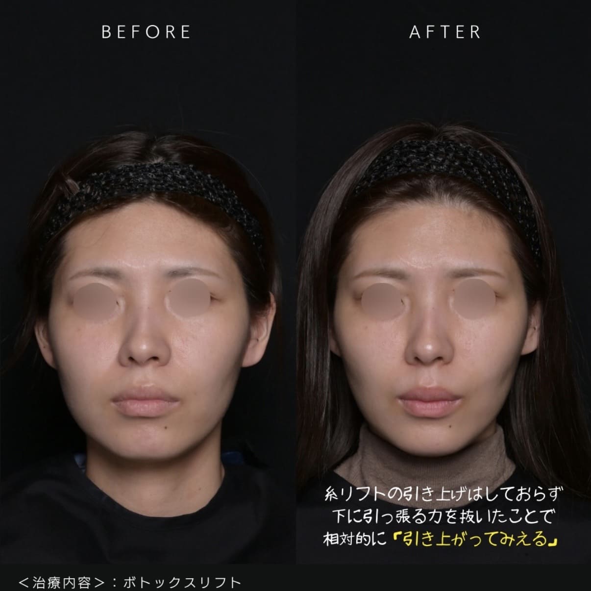 ボトックス注入のビフォーアフター写真