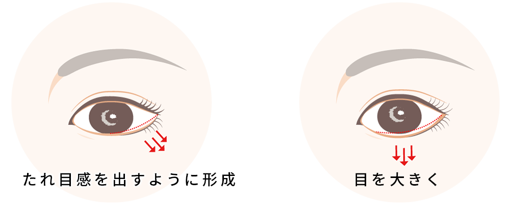 下眼瞼下制術 タレ目形成 ゼティスビューティークリニック 鼻整形 鼻形成 美肌専門美容クリニック